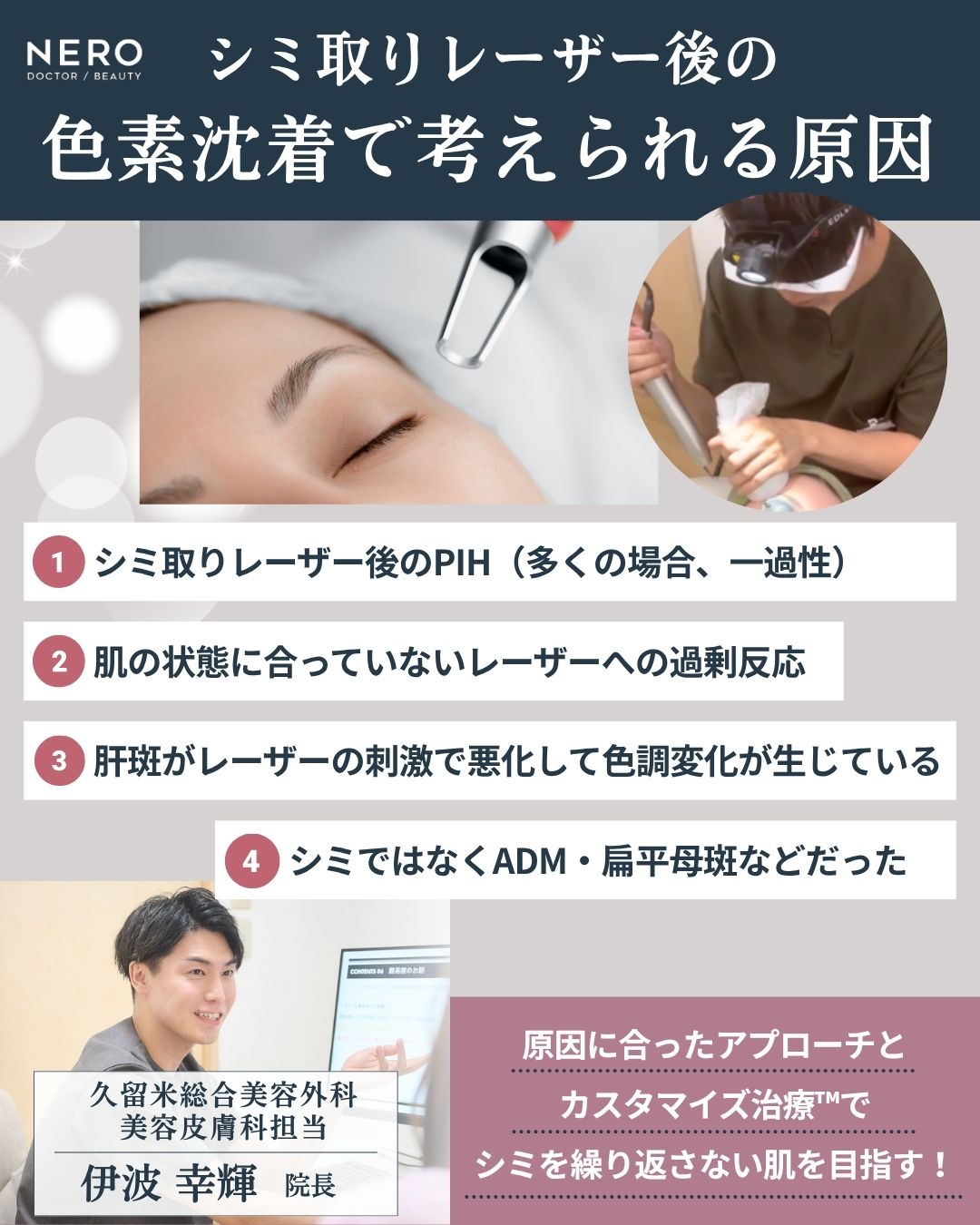 シミ取りレーザー後の色素沈着で考えられる原因