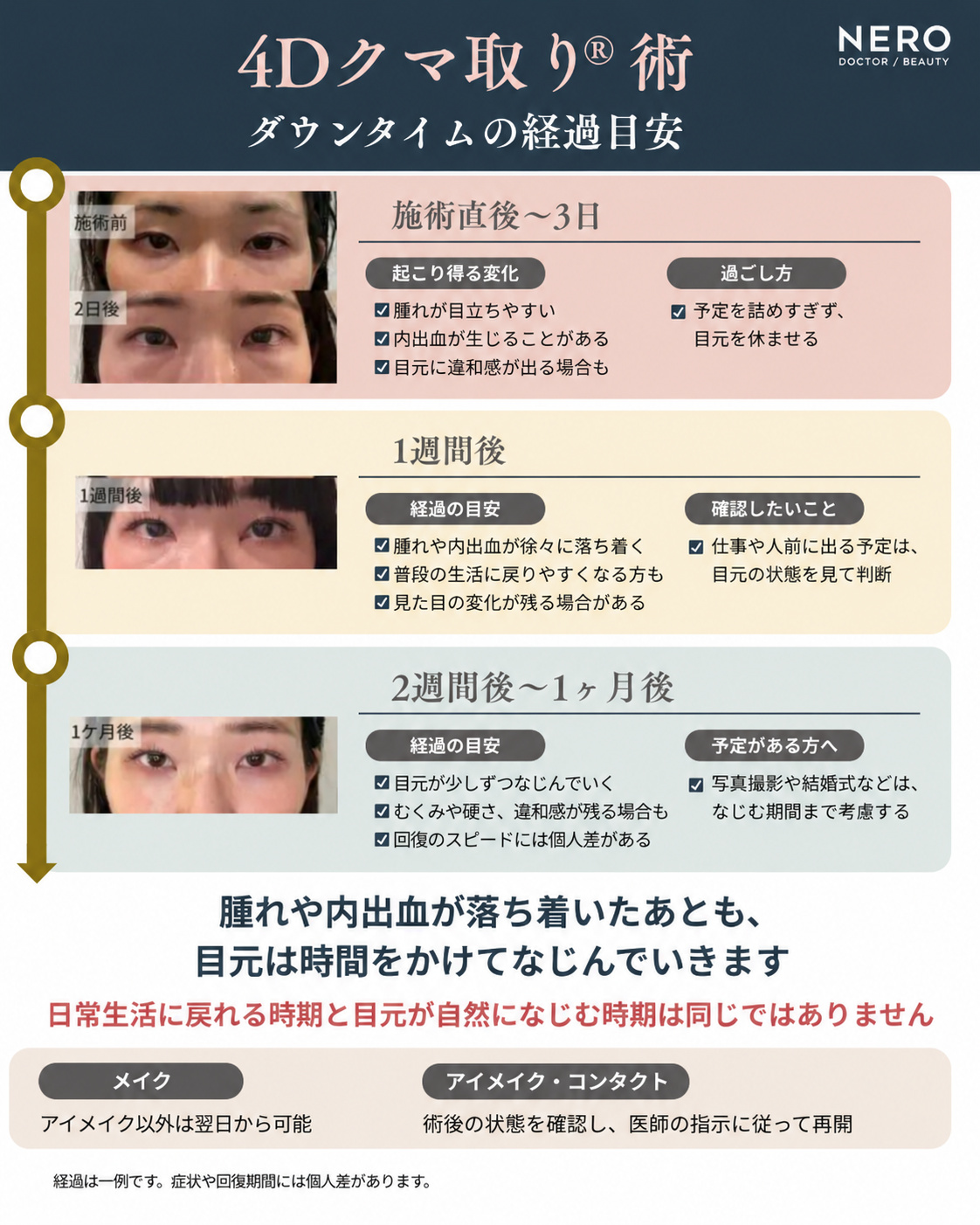 4Dクマ取り術後2日・1週間・1カ月のダウンタイム経過を示した症例写真と目安