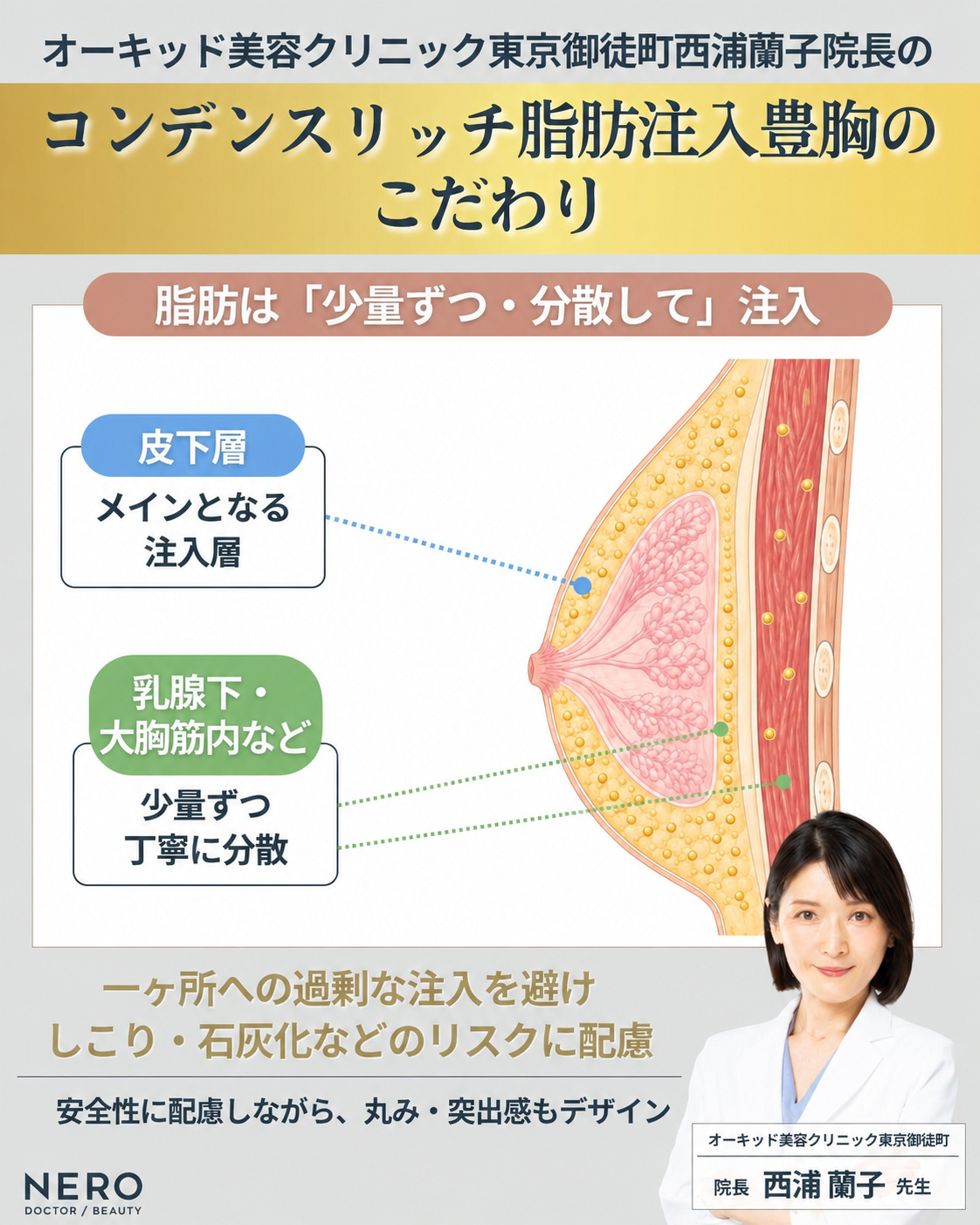 脂肪注入豊胸で脂肪を複数の層へ分散注入する考え方を示した図