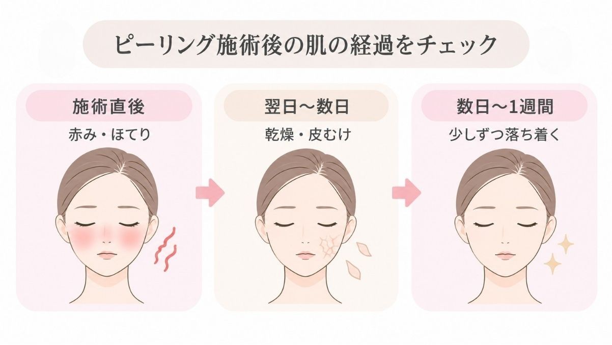 ピーリング後の肌変化を、施術直後・翌日~数日・1週間程度の経過でまとめた図